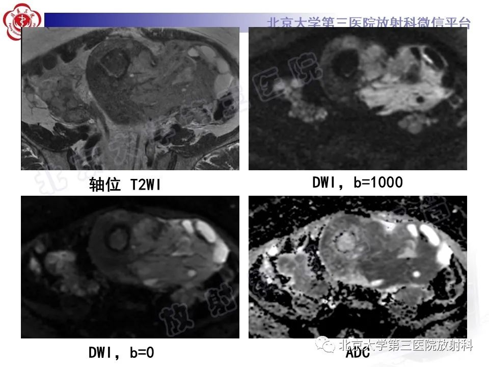 影像PPT - 【PPT】子宫内膜间质肉瘤-11