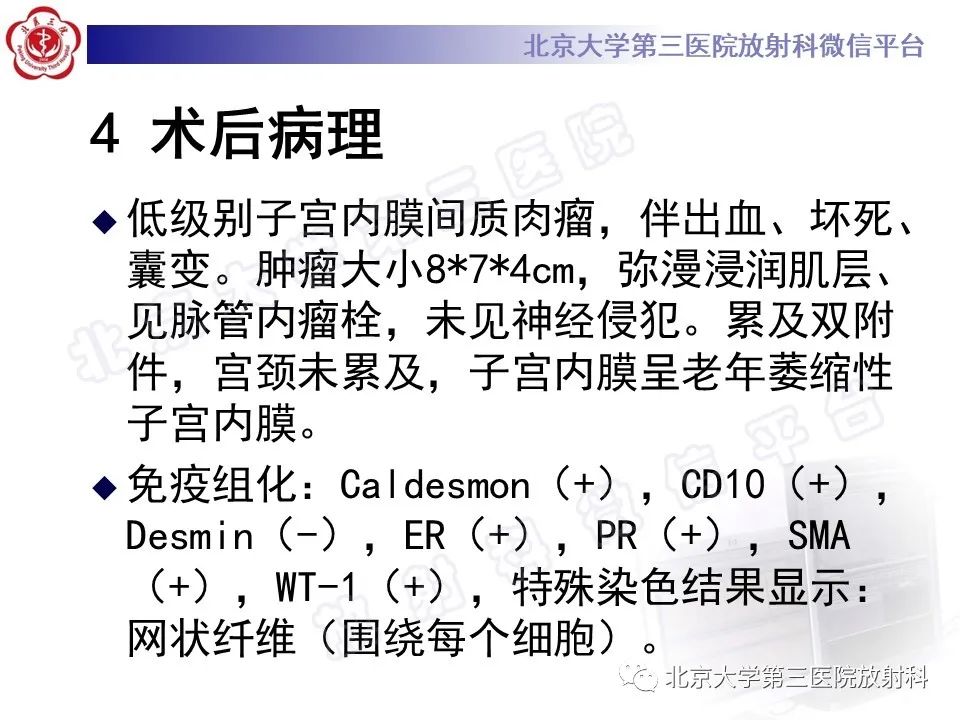 影像PPT - 【PPT】子宫内膜间质肉瘤-15