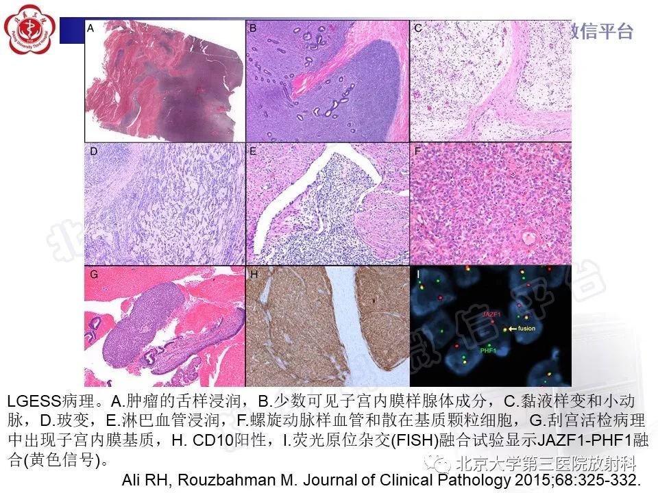 影像PPT - 【PPT】子宫内膜间质肉瘤-22