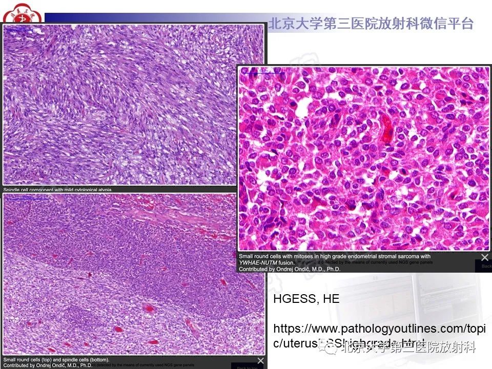 影像PPT - 【PPT】子宫内膜间质肉瘤-23