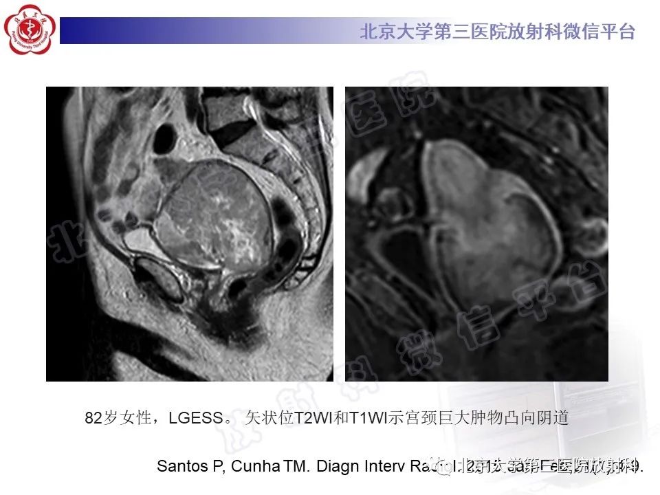 影像PPT - 【PPT】子宫内膜间质肉瘤-26