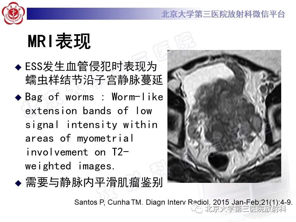 影像PPT - 【PPT】子宫内膜间质肉瘤-28