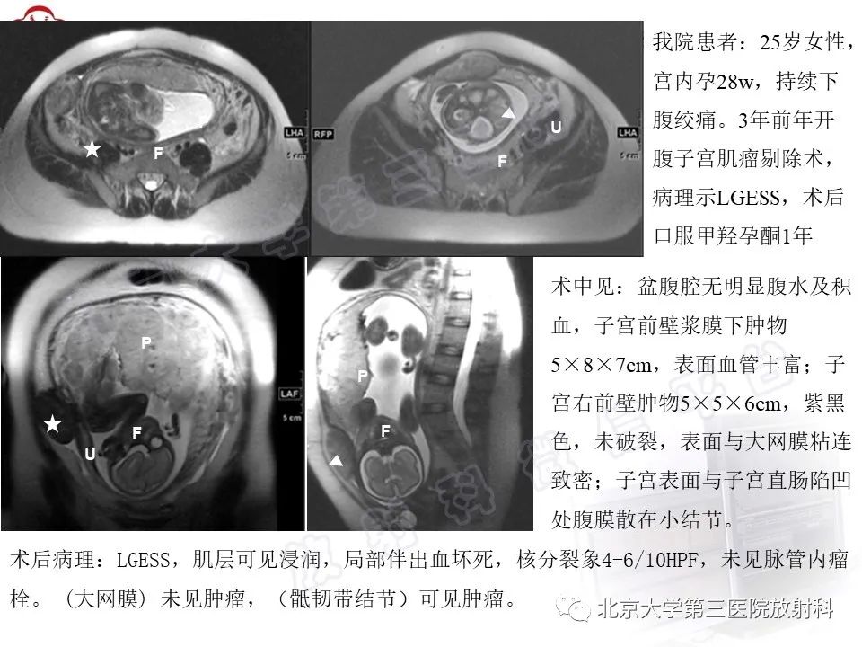 影像PPT - 【PPT】子宫内膜间质肉瘤-27