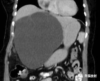 影像PPT - 【病例】胆管囊腺瘤1例CT及MR-6 影像PPT - 【病例】胆管囊腺瘤1例CT及MR-6