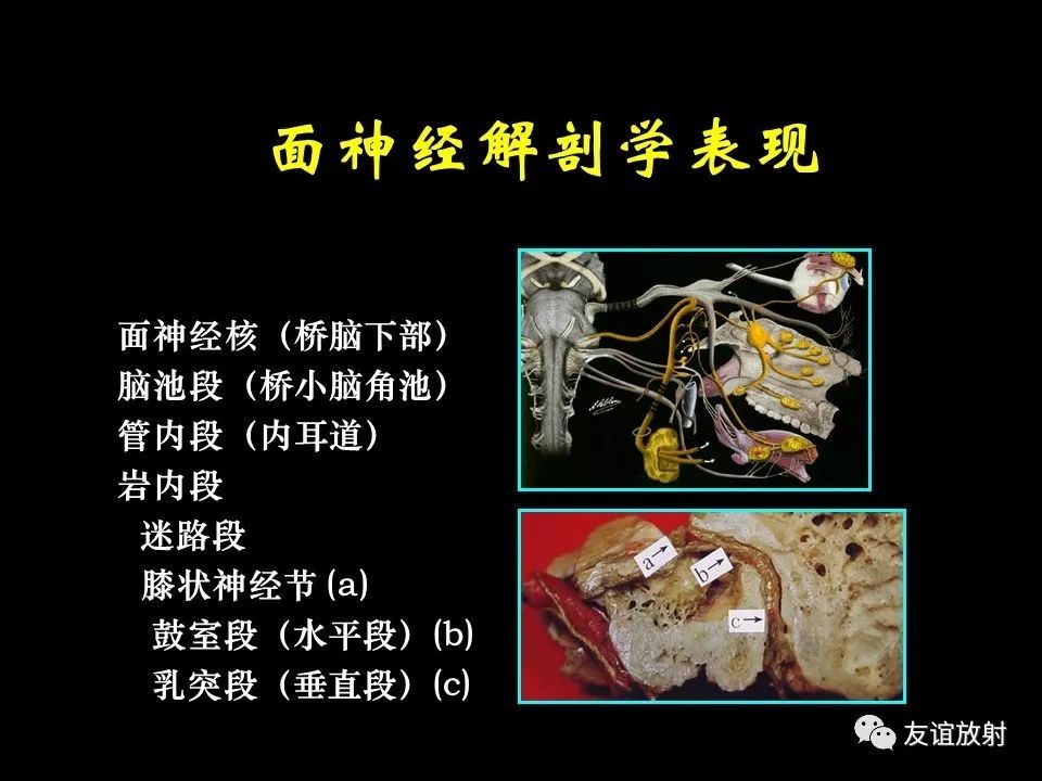 影像PPT - 【PPT】面听神经的MRI-2