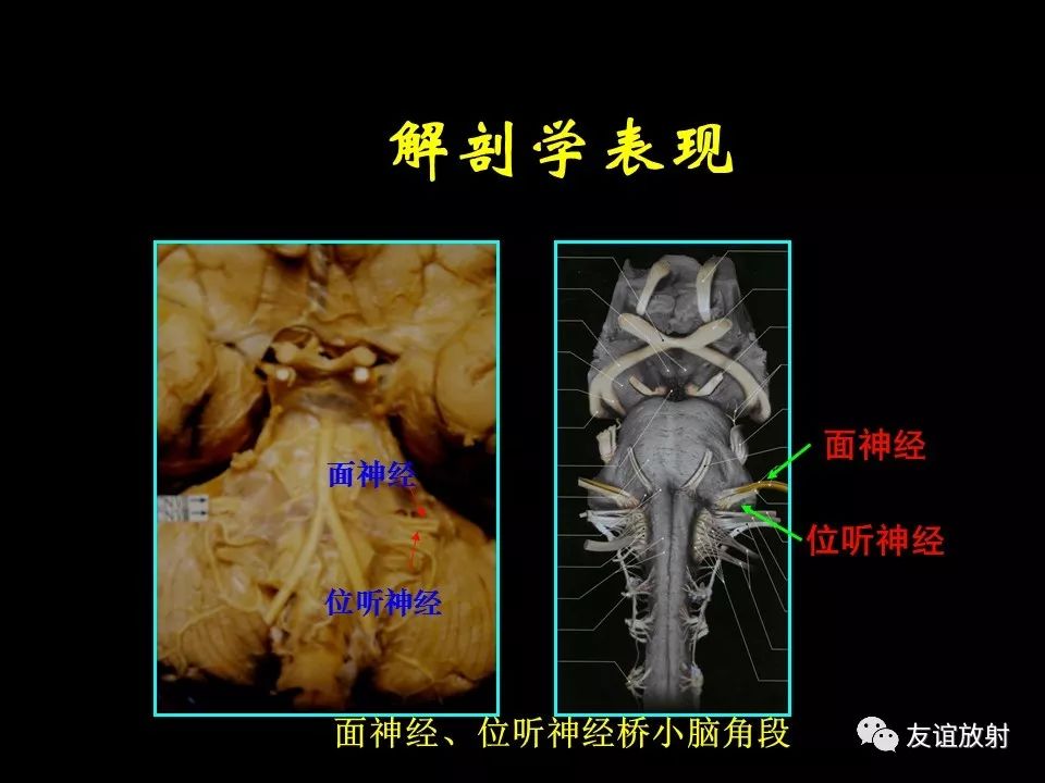 影像PPT - 【PPT】面听神经的MRI-4