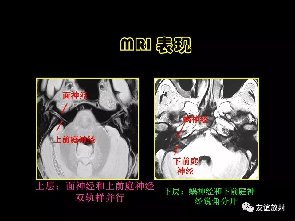 影像PPT - 【PPT】面听神经的MRI-6