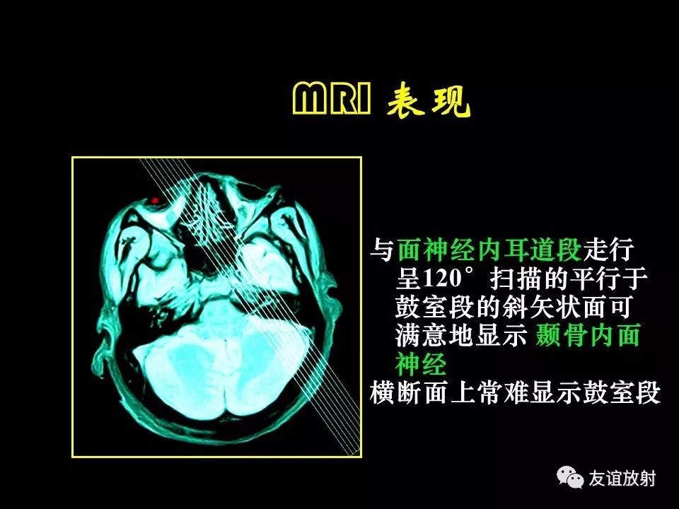 影像PPT - 【PPT】面听神经的MRI-8