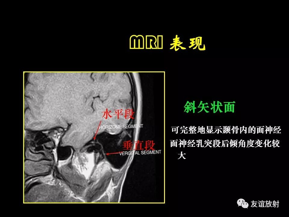 影像PPT - 【PPT】面听神经的MRI-9