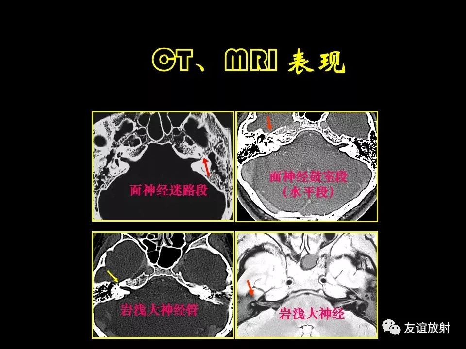 影像PPT - 【PPT】面听神经的MRI-7