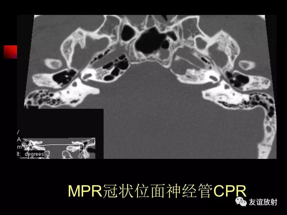 影像PPT - 【PPT】面听神经的MRI-11