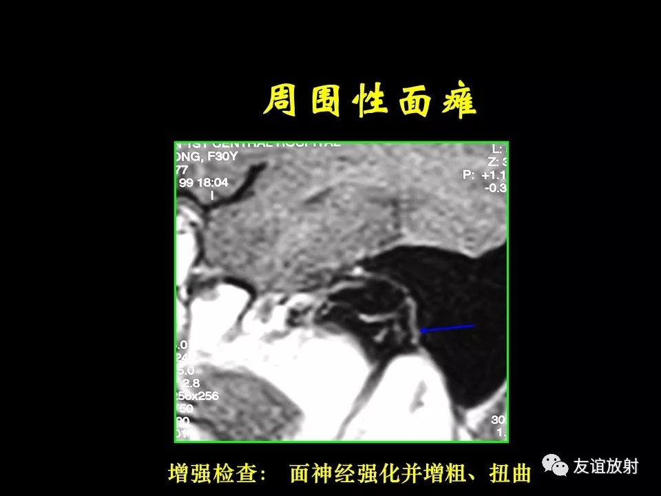 影像PPT - 【PPT】面听神经的MRI-12