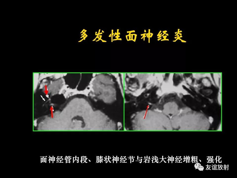影像PPT - 【PPT】面听神经的MRI-15