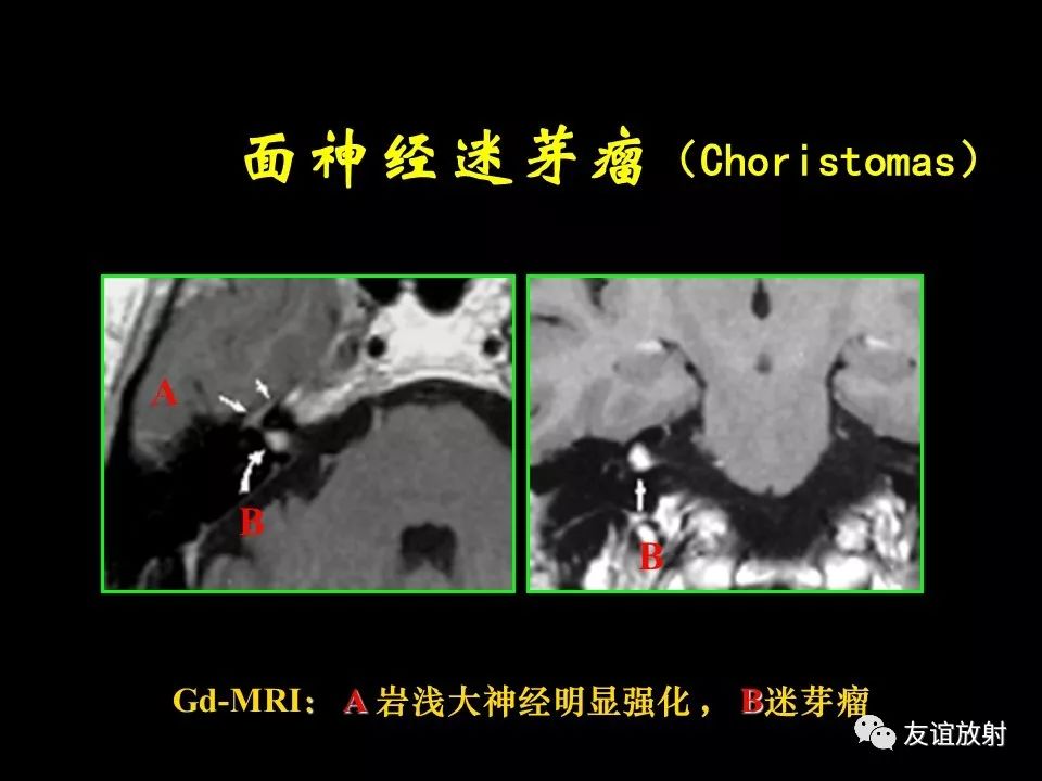 影像PPT - 【PPT】面听神经的MRI-14