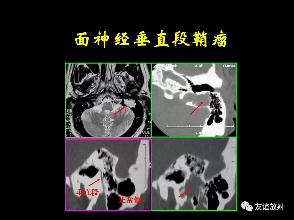 影像PPT - 【PPT】面听神经的MRI-13