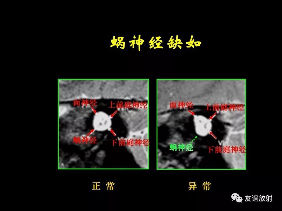 影像PPT - 【PPT】面听神经的MRI-16