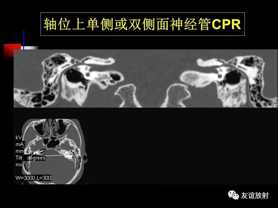 影像PPT - 【PPT】面听神经的MRI-10