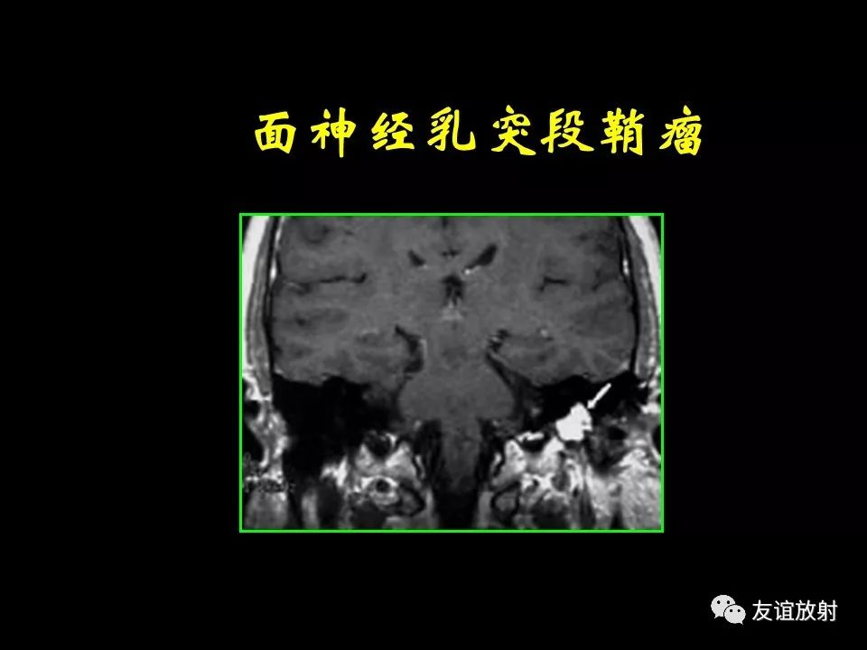 影像PPT - 【PPT】面听神经的MRI-17