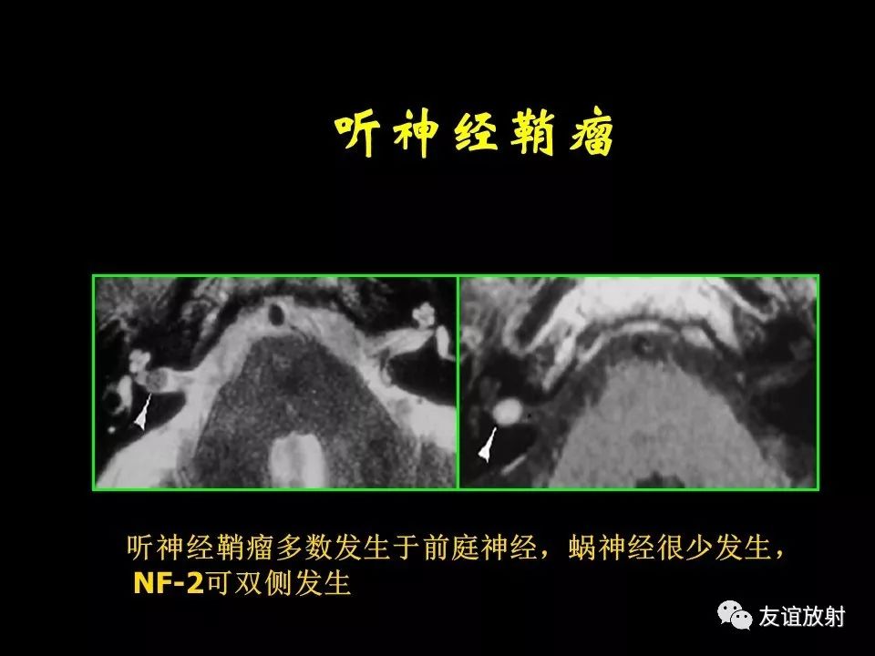 影像PPT - 【PPT】面听神经的MRI-19