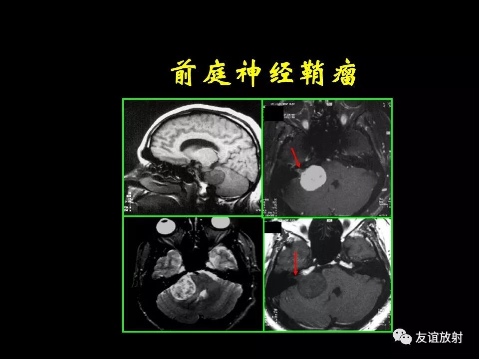 影像PPT - 【PPT】面听神经的MRI-18