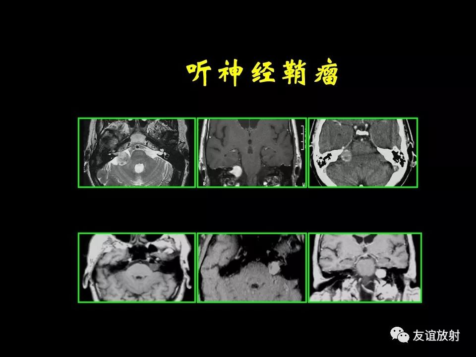 影像PPT - 【PPT】面听神经的MRI-20