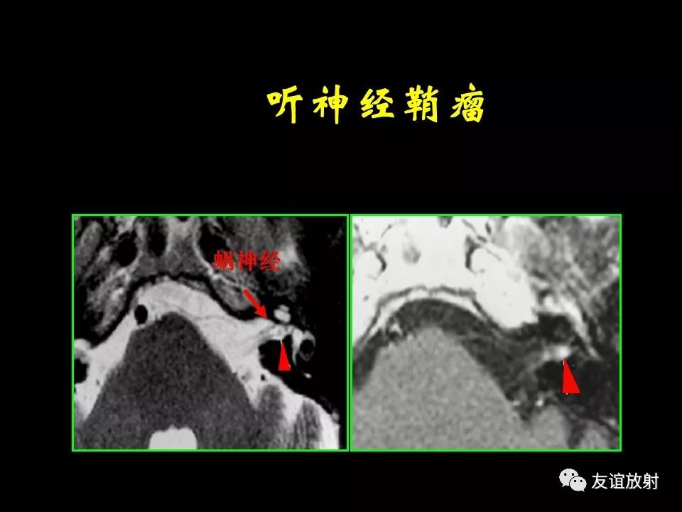影像PPT - 【PPT】面听神经的MRI-21