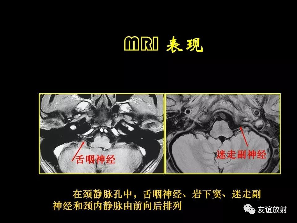 影像PPT - 【PPT】面听神经的MRI-25