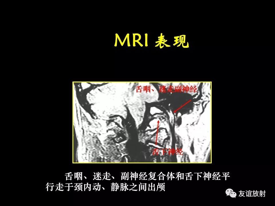 影像PPT - 【PPT】面听神经的MRI-28
