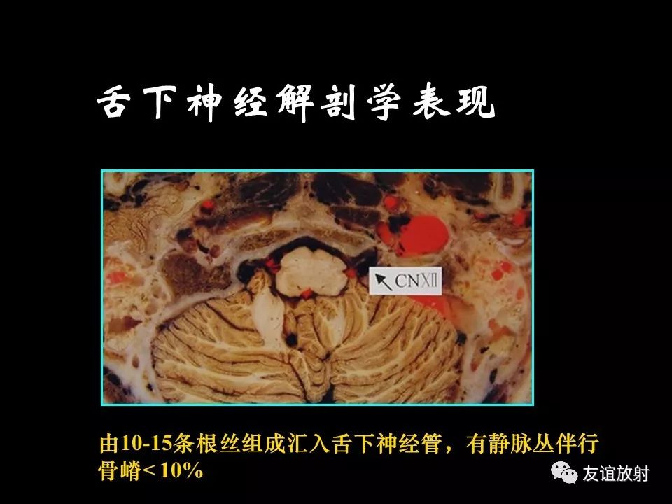 影像PPT - 【PPT】面听神经的MRI-26