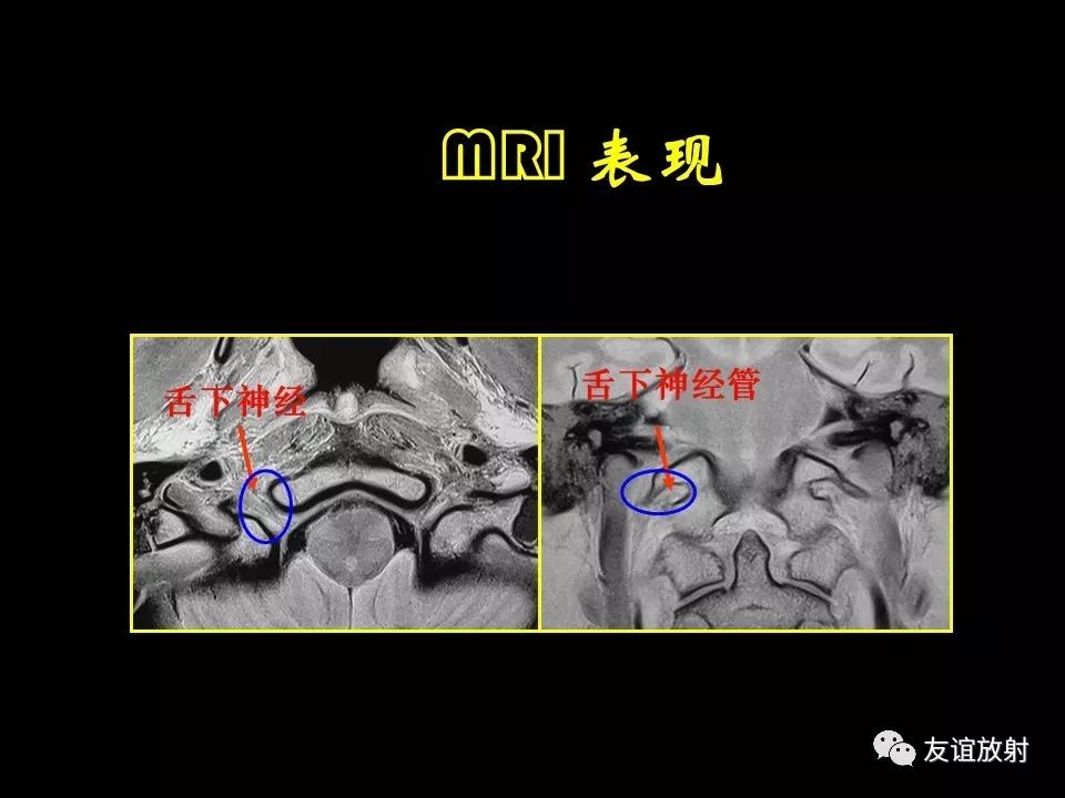 影像PPT - 【PPT】面听神经的MRI-27