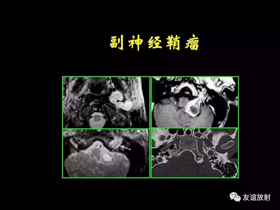 影像PPT - 【PPT】面听神经的MRI-29