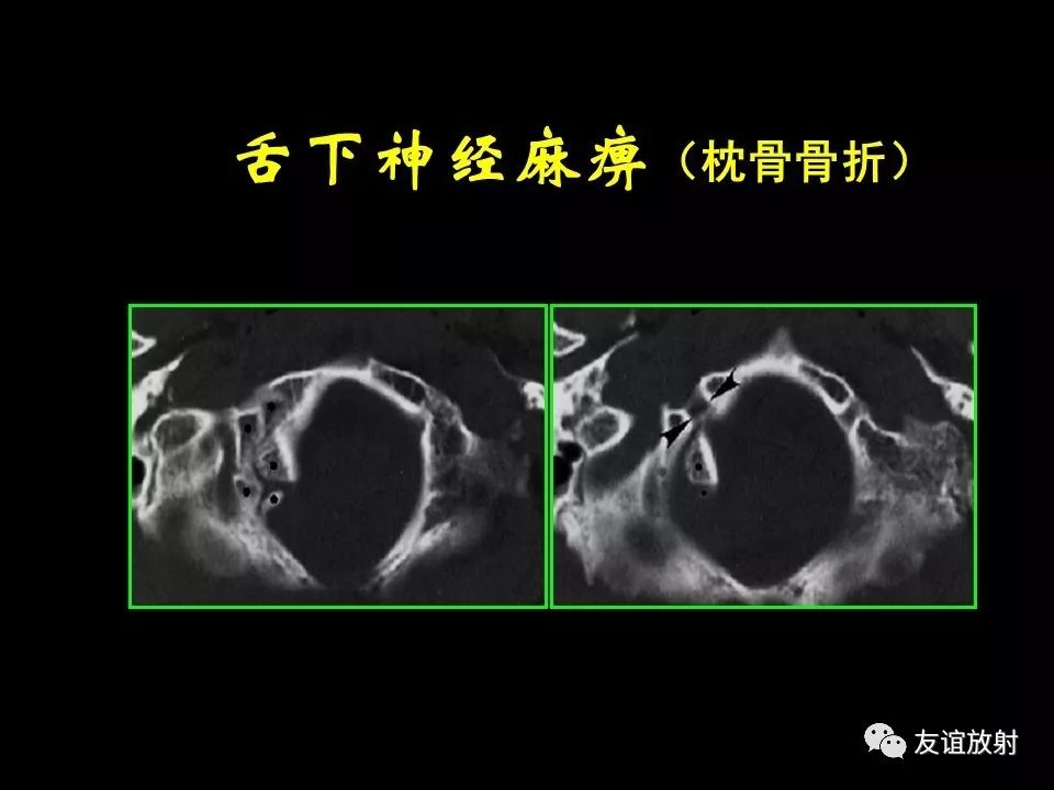 影像PPT - 【PPT】面听神经的MRI-30