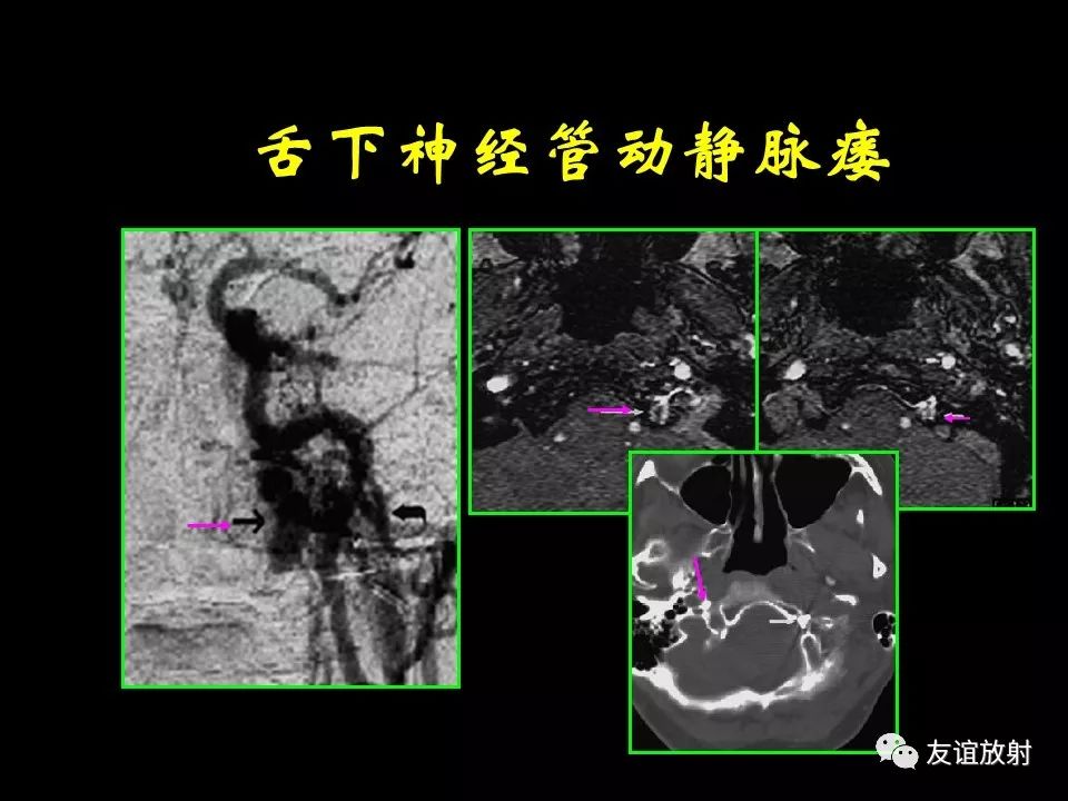 影像PPT - 【PPT】面听神经的MRI-31