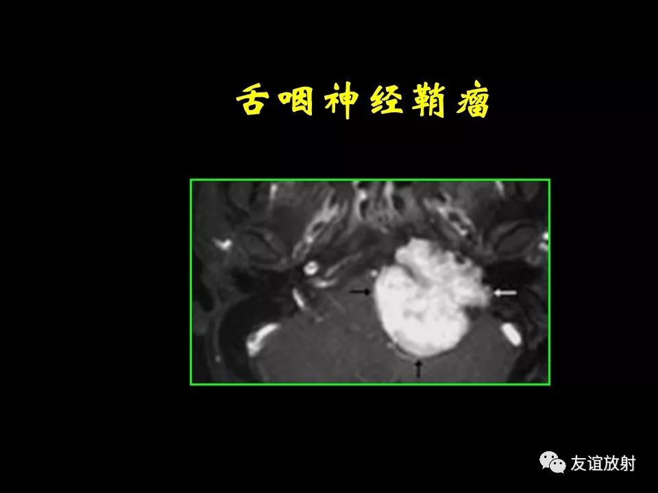 影像PPT - 【PPT】面听神经的MRI-33