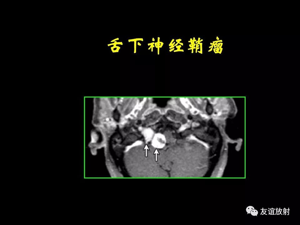 影像PPT - 【PPT】面听神经的MRI-32
