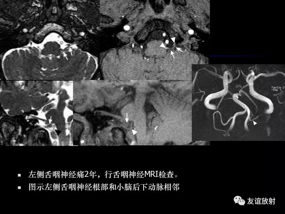 影像PPT - 【PPT】面听神经的MRI-34