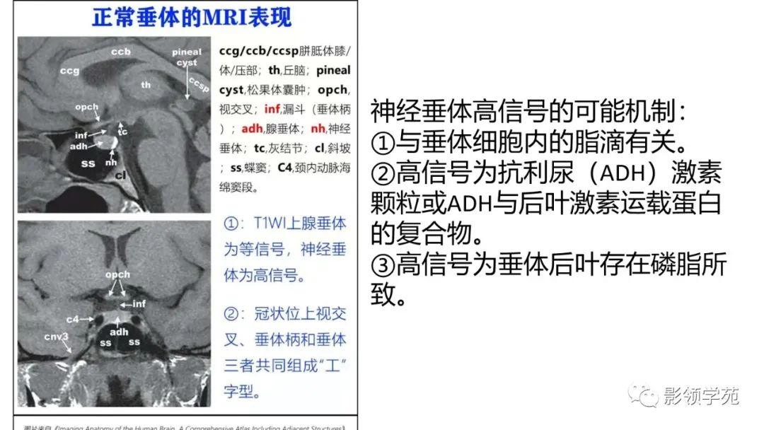 影像PPT - 【PPT】垂体解剖及常见病变影像学表现-10 影像PPT - 【PPT】垂体解剖及常见病变影像学表现-10