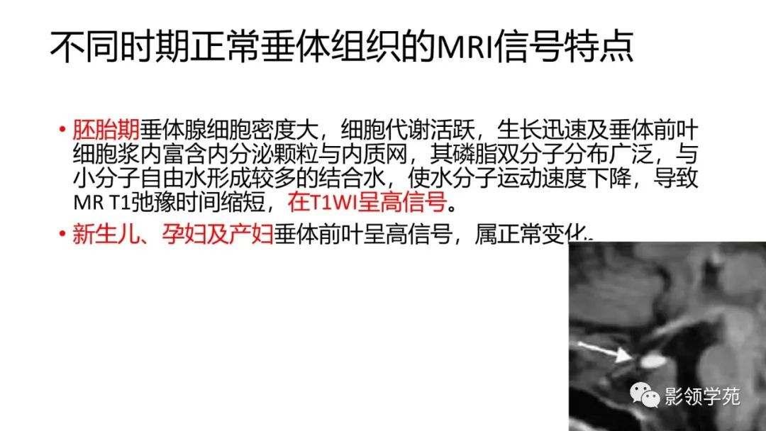 影像PPT - 【PPT】垂体解剖及常见病变影像学表现-12 影像PPT - 【PPT】垂体解剖及常见病变影像学表现-12