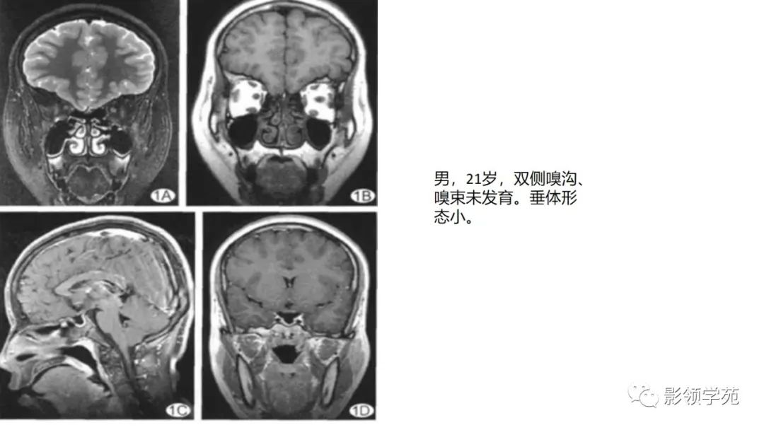 影像PPT - 【PPT】垂体解剖及常见病变影像学表现-28 影像PPT - 【PPT】垂体解剖及常见病变影像学表现-28