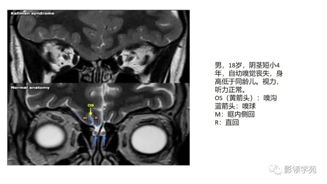 影像PPT - 【PPT】垂体解剖及常见病变影像学表现-27 影像PPT - 【PPT】垂体解剖及常见病变影像学表现-27