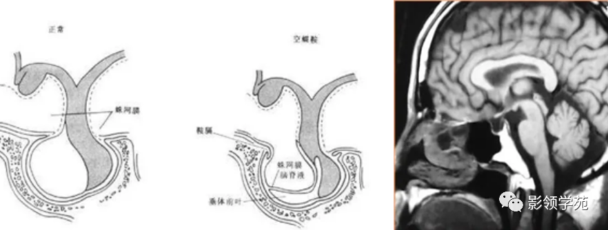影像PPT - 【PPT】垂体解剖及常见病变影像学表现-32 影像PPT - 【PPT】垂体解剖及常见病变影像学表现-32