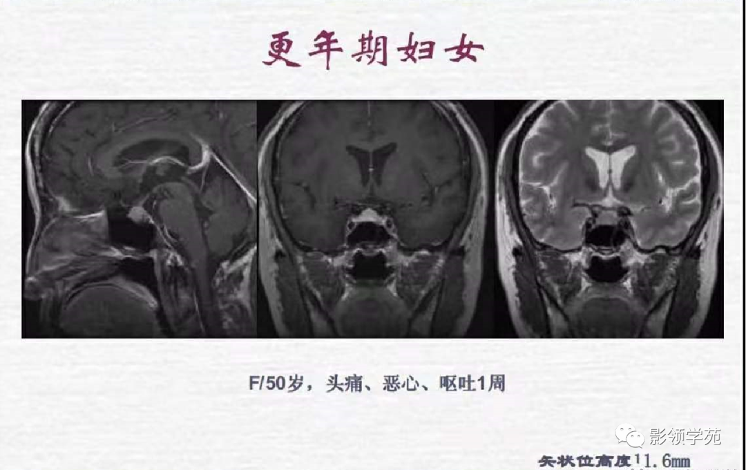 影像PPT - 【PPT】垂体解剖及常见病变影像学表现-37 影像PPT - 【PPT】垂体解剖及常见病变影像学表现-37