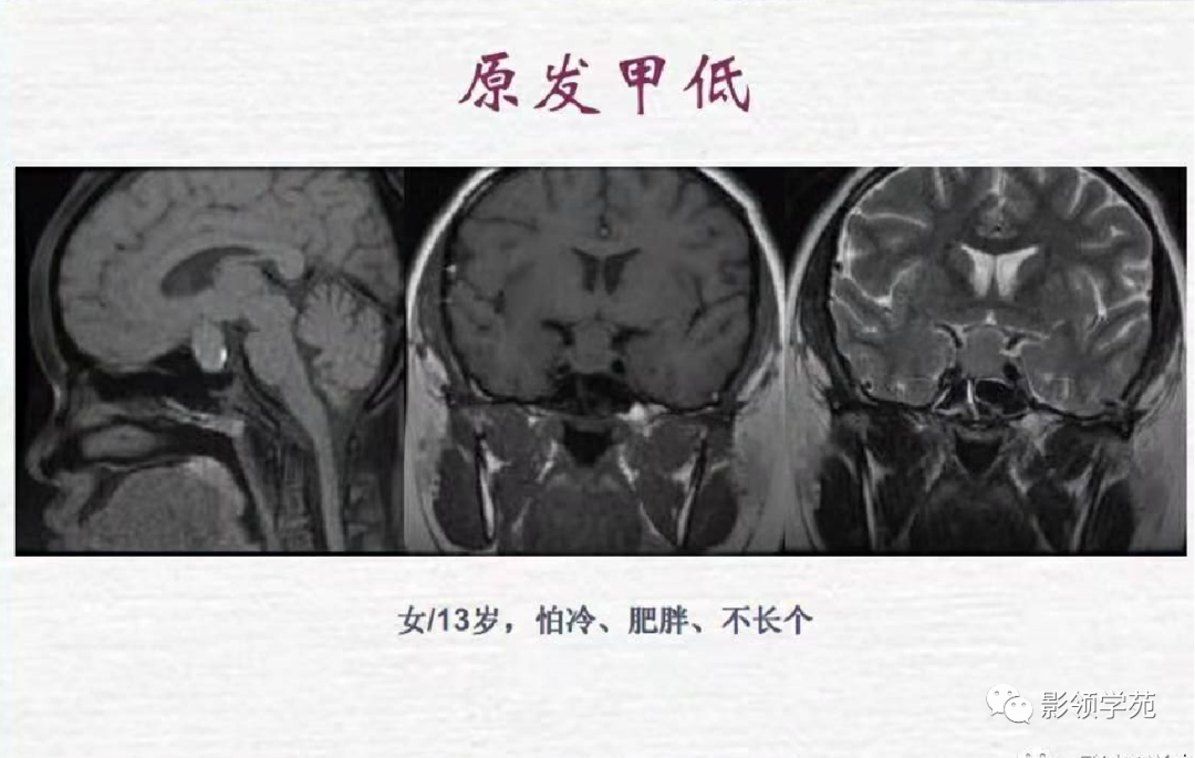 影像PPT - 【PPT】垂体解剖及常见病变影像学表现-38 影像PPT - 【PPT】垂体解剖及常见病变影像学表现-38