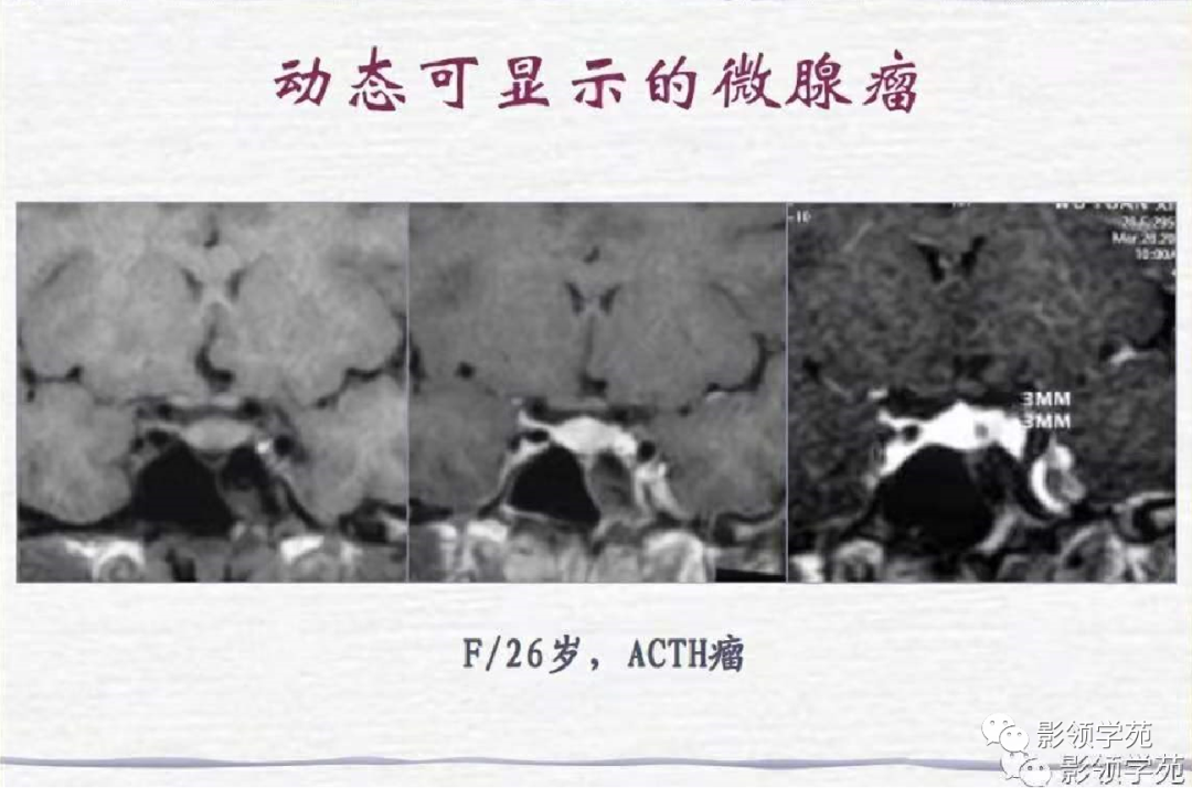 影像PPT - 【PPT】垂体解剖及常见病变影像学表现-41 影像PPT - 【PPT】垂体解剖及常见病变影像学表现-41