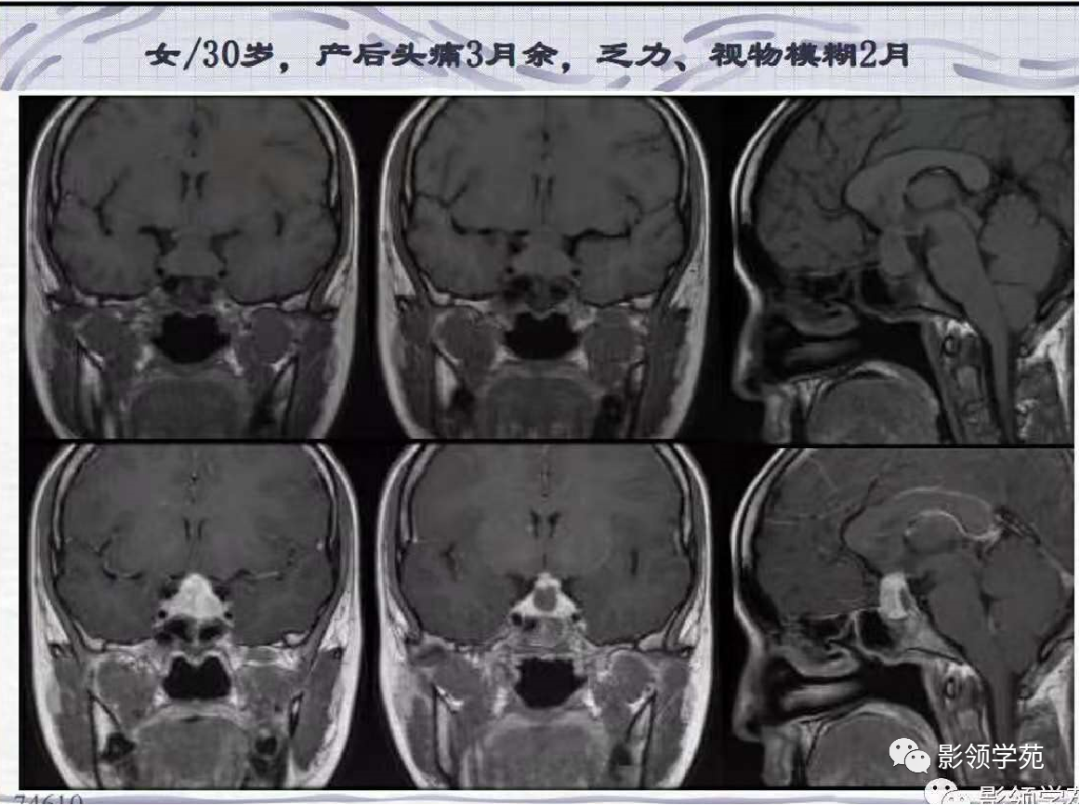 影像PPT - 【PPT】垂体解剖及常见病变影像学表现-46 影像PPT - 【PPT】垂体解剖及常见病变影像学表现-46