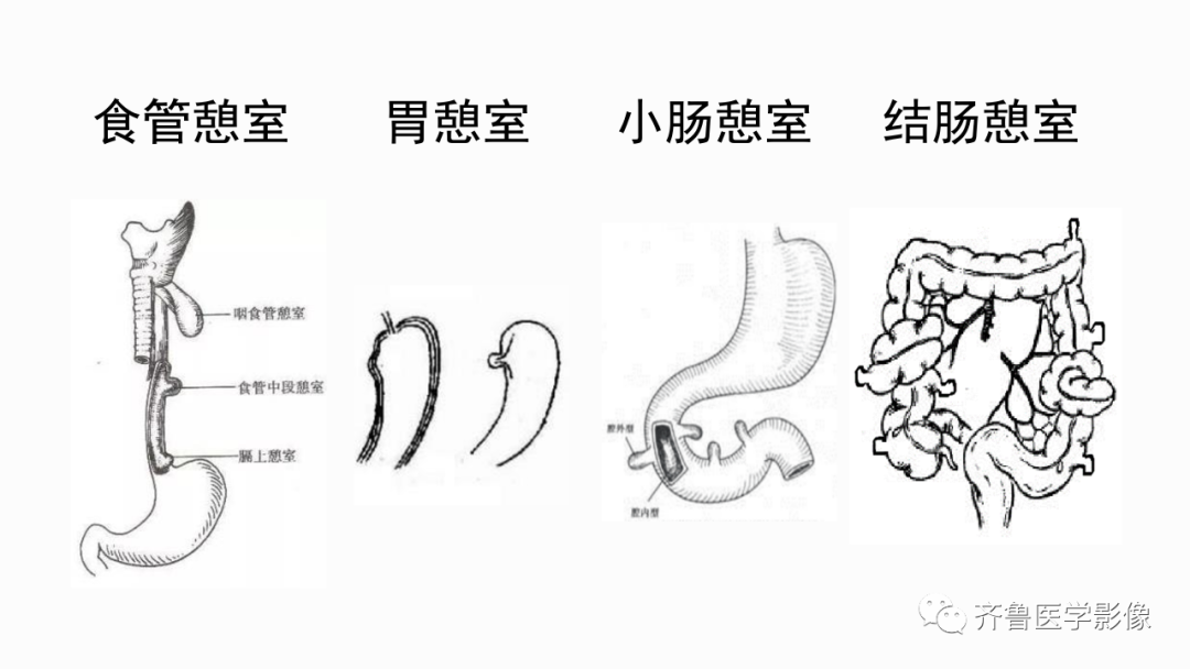 影像PPT - 【PPT】消化道憩室-3