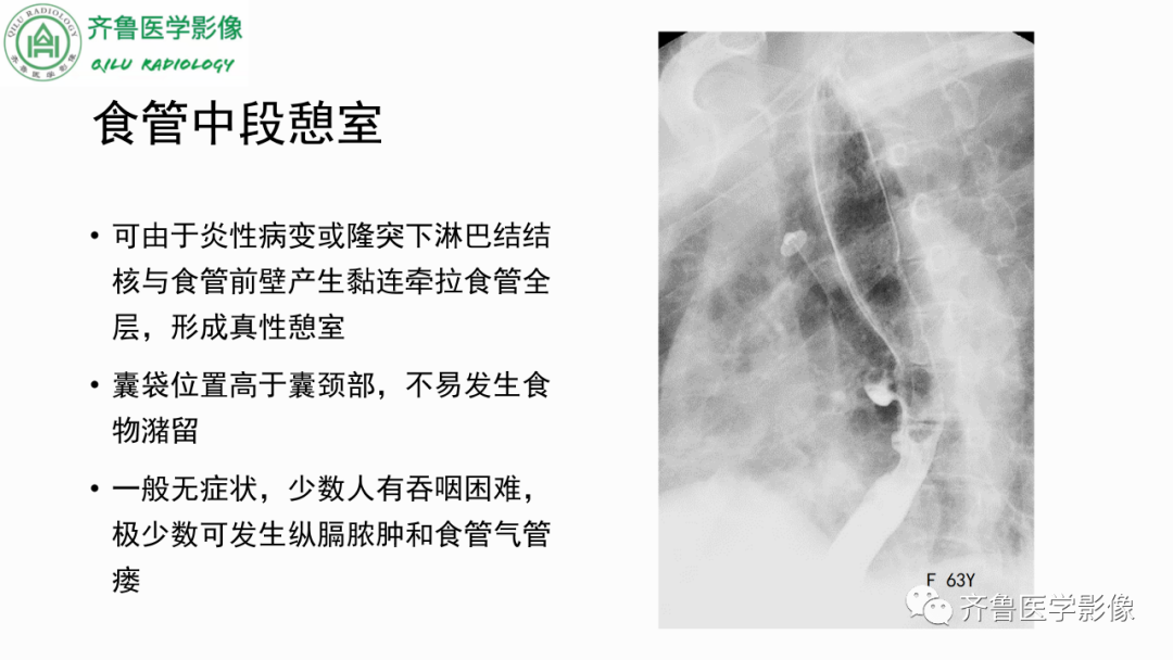影像PPT - 【PPT】消化道憩室-5