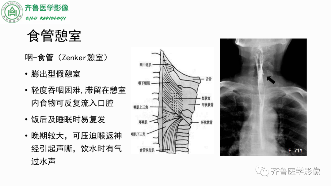 影像PPT - 【PPT】消化道憩室-4