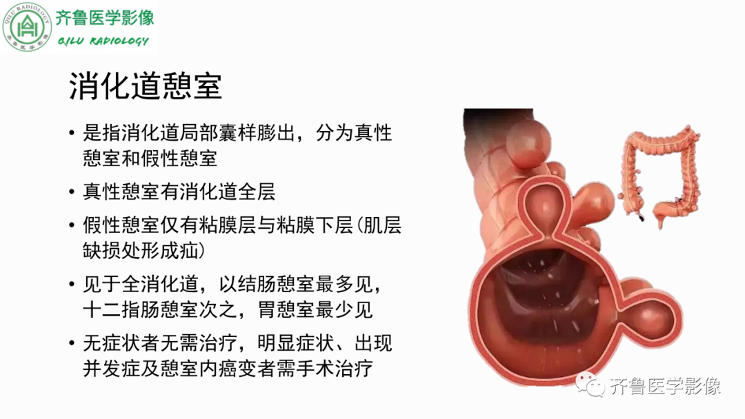 影像PPT - 【PPT】消化道憩室-2