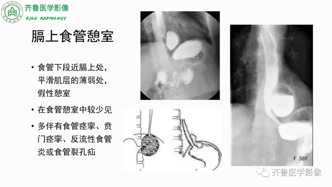 影像PPT - 【PPT】消化道憩室-6